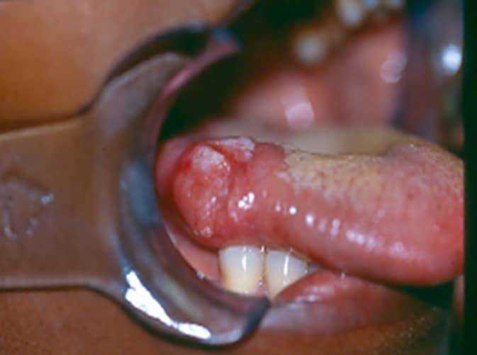 Oral Cancer